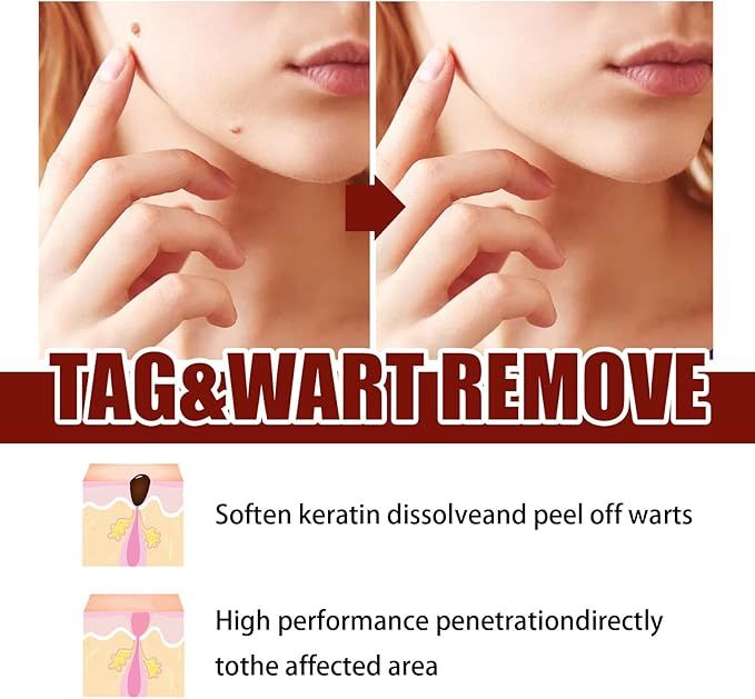 Wipe-Off Skin Tag and Mole Remover Pen with Natural Tea Tree Oil for face, neck, and body – gentle and effective home skincare treatment.