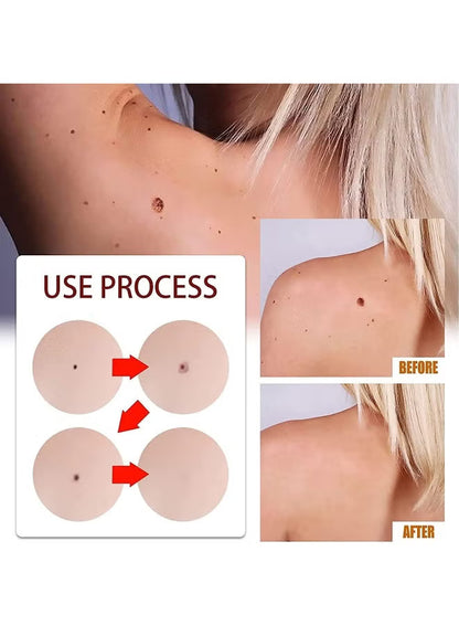 Wipe-Off Skin Tag and Mole Remover Pen with Natural Tea Tree Oil for face, neck, and body – gentle and effective home skincare treatment.