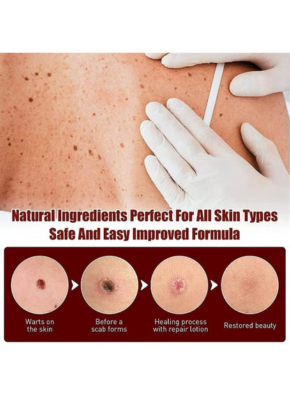 Wipe-Off Skin Tag and Mole Remover Pen with Natural Tea Tree Oil for face, neck, and body – gentle and effective home skincare treatment.